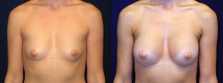 Frontal View - Breast Augmentation - Silicone Implants