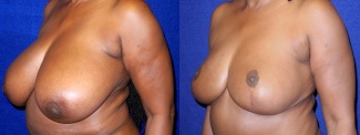 Left 3/4 View - Breast Reduction After Pregnancy