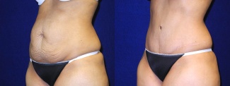 Left 3/4 View - Tummy Tuck After Pregnancy