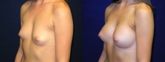 Left 3/4 View - Breast Augmentation - Silicone Implants