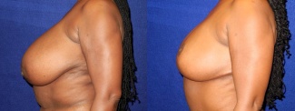 Left Profile View - Breast Reduction After Pregnancy