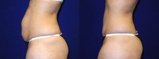 Left Profile View - Tummy Tuck After Pregnancy