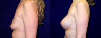 Left Profile View - Breast Implant Revision - Silicone Implants