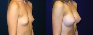 Right 3/4 View - Breast Augmentation - Silicone Implants