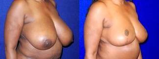 Right 3/4 View - Breast Reduction After Pregnancy