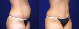 Right 3/4 View - Tummy Tuck After Pregnancy