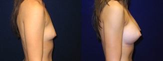 Right Profile View - Breast Augmentation - Silicone Implants