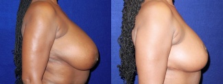 Right Profile View - Breast Reduction After Pregnancy