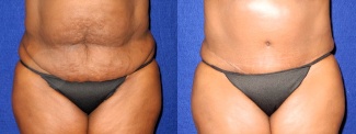 Frontal View - Tummy Tuck After Pregnancy