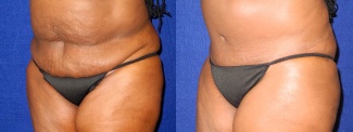 Left 3/4 View - Tummy Tuck After Pregnancy