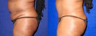 Left Profile View - Tummy Tuck After Pregnancy