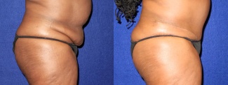 Right Profile View - Tummy Tuck After Pregnancy