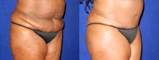 Right 3/4 View - Tummy Tuck After Pregnancy