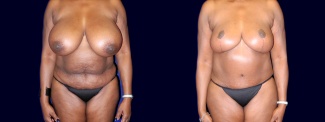 Frontal View - Breast Reduction and Tummy Tuck After Pregnancy