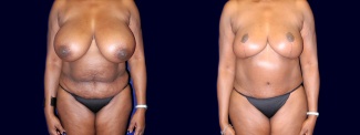 Frontal View - Breast Reduction and Tummy Tuck After Pregnancy