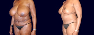 Left 3/4 View - Breast Reduction and Tummy Tuck After Pregnancy