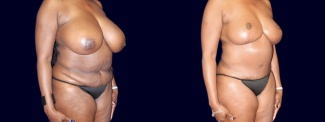 Right 3/4 View - Breast Reduction and Tummy Tuck After Pregnancy