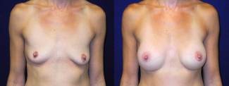 Frontal View - Breast Augmentation - Silicone Implants