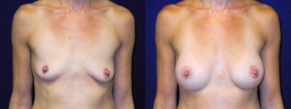 Frontal View - Breast Augmentation - Silicone Implants