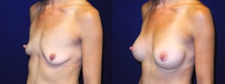 Left 3/4 View - Breast Augmentation - Silicone Implants