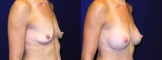 Right 3/4 View - Breast Augmentation - Silicone Implants