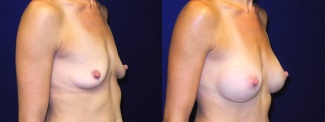 Right 3/4 View - Breast Augmentation - Silicone Implants