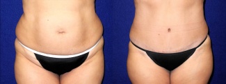 Frontal View - Tummy Tuck and Liposuction