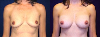 Frontal View - Breast Augmentation - Silicone Implants