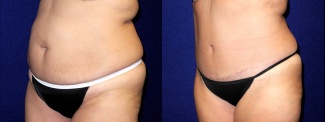 Left 3/4 View - Tummy Tuck and Liposuction