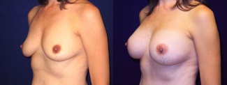 Left 3/4 View - Breast Augmentation - Silicone Implants