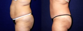 Left Profile View - Tummy Tuck and Liposuction