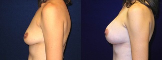 Left Profile View - Breast Augmentation - Silicone Implants