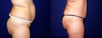 Right Profile View - Tummy Tuck and Liposuction