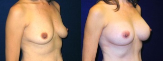 Right 3/4 View - Breast Augmentation - Silicone Implants