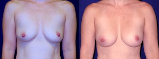 Frontal View - Breast Augmentation After Pregnancy