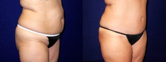 Right 3/4 View - Tummy Tuck and Liposuction