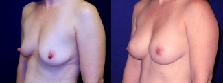 Left 3/4 View - Breast Augmentation After Pregnancy