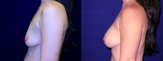 Left Profile View - Breast Augmentation After Pregnancy