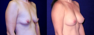 Right 3/4 View - Breast Augmentation After Pregnancy