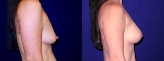 Right Profile View - Breast Augmentation After Pregnancy