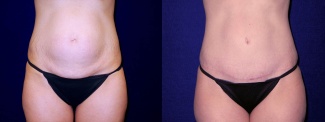 Frontal View - Tummy Tuck After Pregnancy