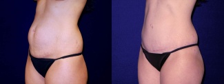 Left 3/4 View - Tummy Tuck After Pregnancy