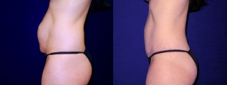 Left Profile View - Tummy Tuck After Pregnancy