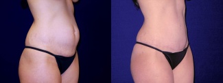 Right 3/4 View - Tummy Tuck After Pregnancy