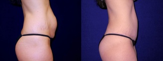 Right Profile View - Tummy Tuck After Pregnancy