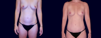 Frontal View - Breast Augmentation and Tummy Tuck After Pregnancy