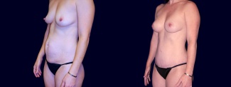 Left 3/4 View - Breast Augmentation and Tummy Tuck After Pregnancy