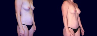 Right 3/4 View - Breast Augmentation and Tummy Tuck After Pregnancy