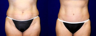 Frontal View - Tummy Tuck After Pregnancy