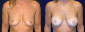 Frontal View - Breast Augmentation - Silicone Implants